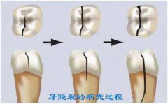 牙齒開裂的原因及治療方法