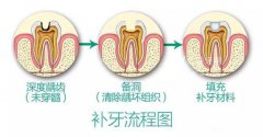 補牙時為(wèi)什麽還要磨牙齒