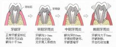 牙體(tǐ)缺損修複的注意事項