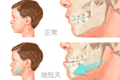 如何判斷地包天