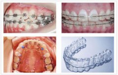 兒童牙齒矯正有哪些方法