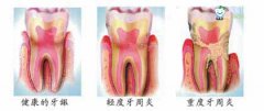 不同程度的牙周炎，治療需“區(qū)别對待”!