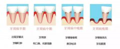 自查“口腔殺手”牙周炎具體(tǐ)該怎麽進行