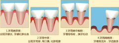 得了牙周炎有可(kě)能(néng)禍害的是整口牙 你知道嗎?