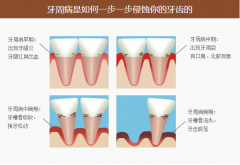 成年人牙龈出血牙周炎沒什麽大不了嗎?