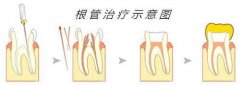 牙髓炎有哪些治療方法及治療原則?