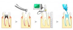 牙髓炎根管治療及注意事項