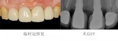 前牙種植烤瓷冠修複
