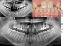 先天牙缺失種植來修複